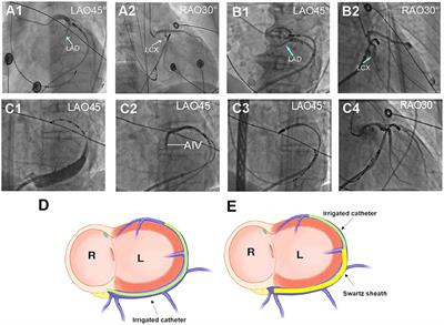 Catheter Ablation of Ventricular Arrhythmias Originating From the Region of DGCV-AIV via a Swartz Sheath Support Approach